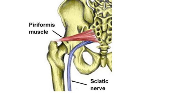 Piriformis syndrome
