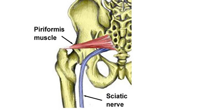 Piriformis syndrome