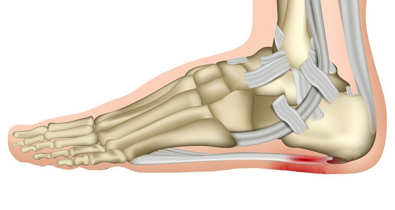 Your Plantar Fasciitis Symptoms Might Actually Be Heel Bone Cysts or Tumors  | Weil Foot & Ankle Institute