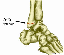 Pott's ankle fracture