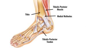 Posterior tibial tendon dysfunction / syndrome