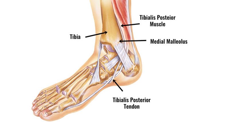 Posterior tibial tendon dysfunction / syndrome