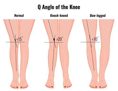 normal and abnormal q angle of the knee