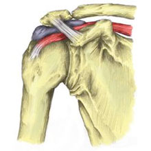 Subacromial Bursitis