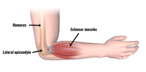 Tennis elbow - extensor muscles of the wrist