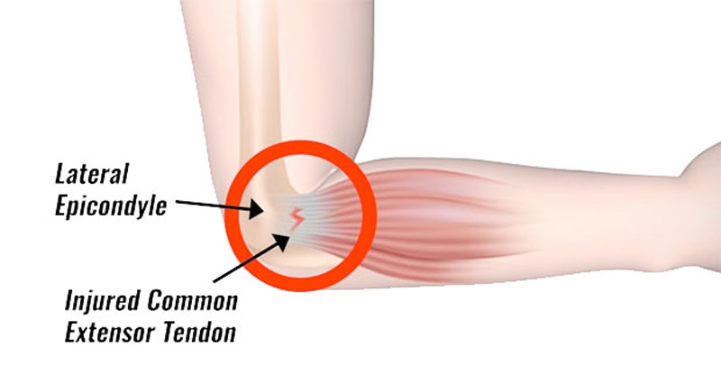 The iliotibial band and site of injury at lateral epicondyle of