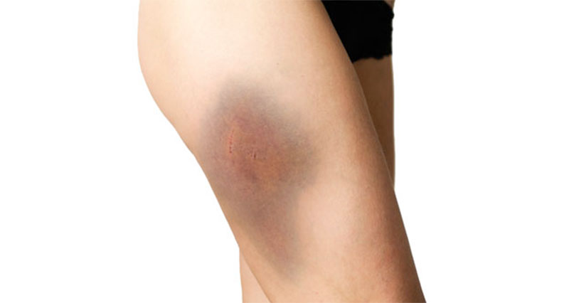 Thigh contusion