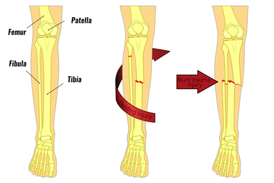 Lower leg fractures