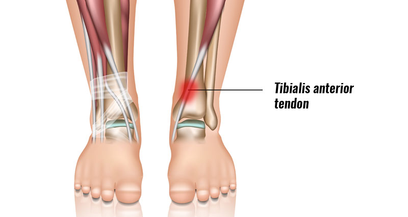 Tibialis Anterior Tendonitis (Tendinopathy) - Symptoms, Causes, Treatment