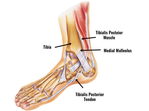 Posterior Tibial Tendon Dysfunction PTTD Symptoms Treatment Posterior Tibial Tendon Dysfunction PTTD Symptoms Treatment