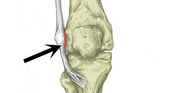 Iliotibial band friction syndrome