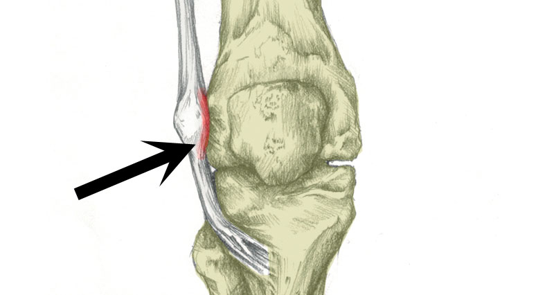 Iliotibial band friction syndrome