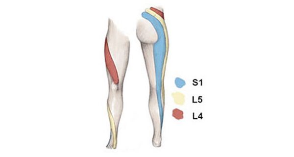 Sciatica