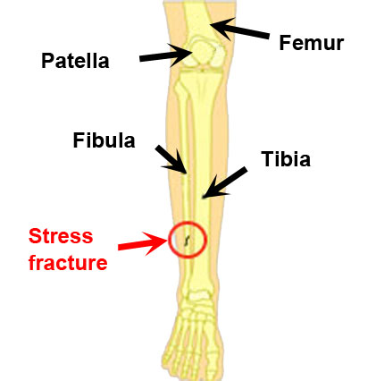 Artistiek Koor Consequent Fibula Stress Fracture - Symptoms, Causes, Treatment & Rehabilitation