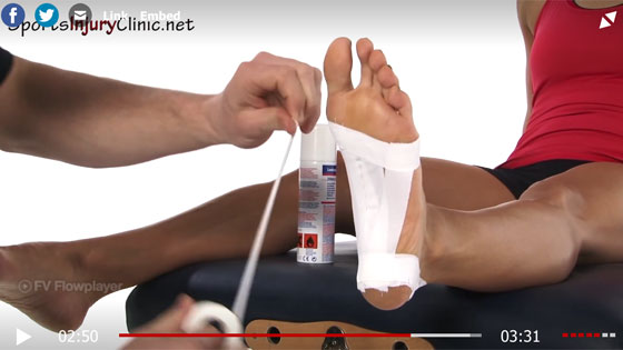 Lateral Plantar Nerve Entrapment Symptoms Causes Treatment