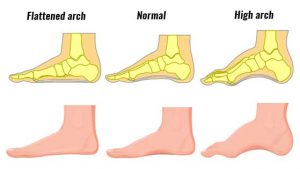 Supination (Foot Biomechanics) Explained - Types, Causes & Treatment