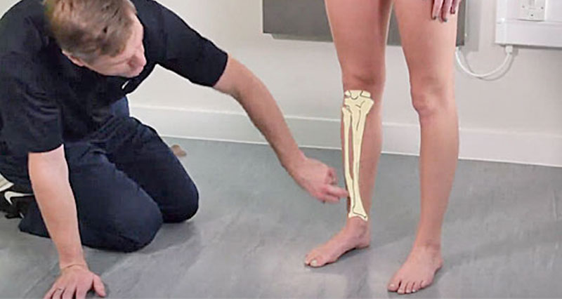 Shin splints taping