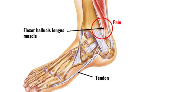 Flexor hallucis longus tendinopathy