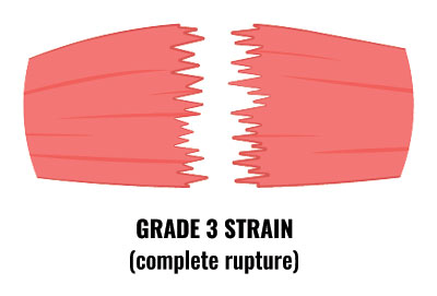 Grade 3 muscle strain