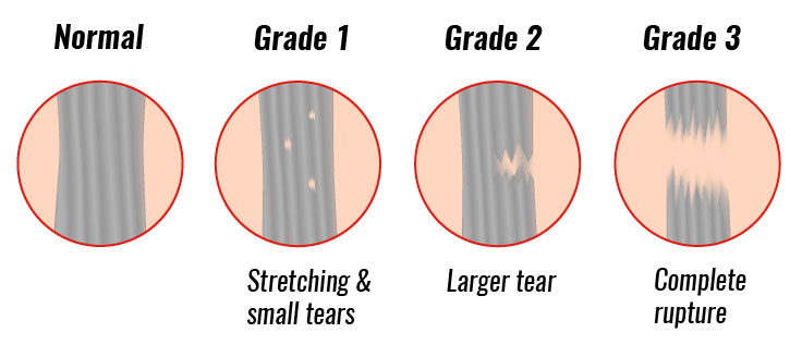 Grades of ligament tear