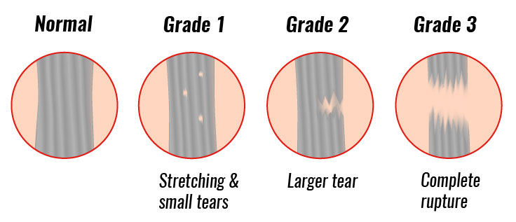 MCL sprain diagnosis