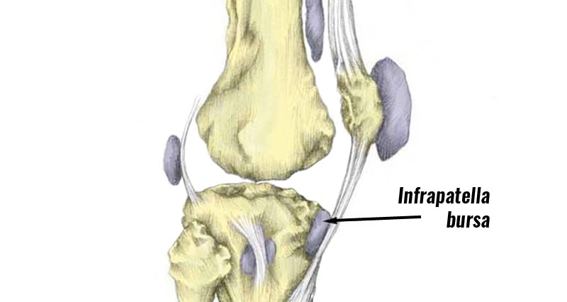 Infrapatella bursitis