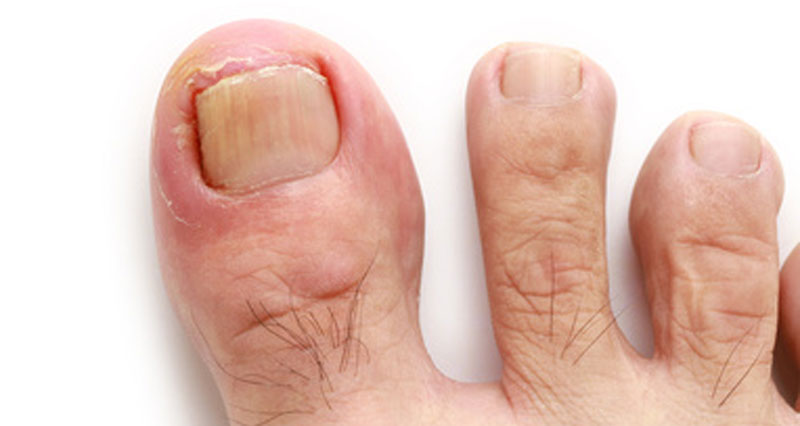 Ingrown Toenail (Onychocryptosis): Symptoms & Treatment