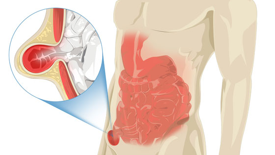 Inguinal hernia