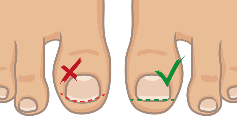 Prevent ingrowing toenails