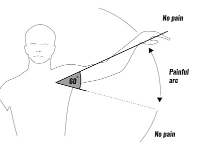 Shoulder impingement pain arc