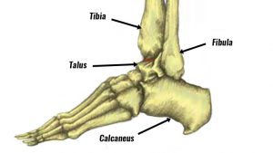 Dislocated ankle bones