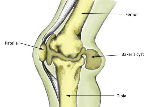 Baker's Cyst - Symptoms, Causes, Treatment and Rehabilitation