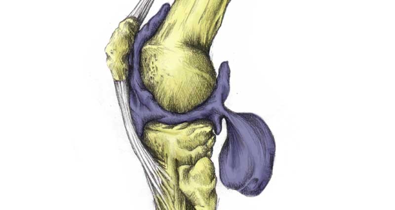 Bakers Cyst