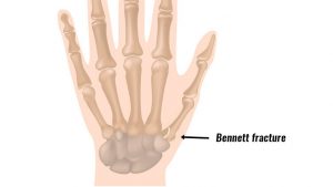 Bennett's fracture