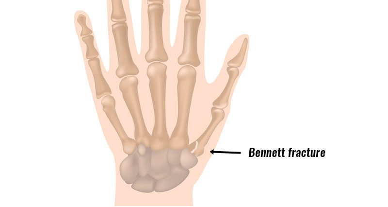 Bennett's fracture