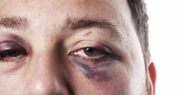 Black eye