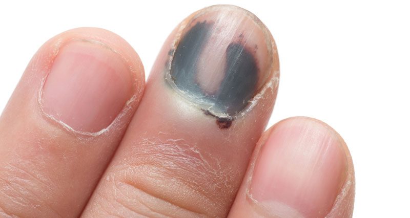 Black fingernail