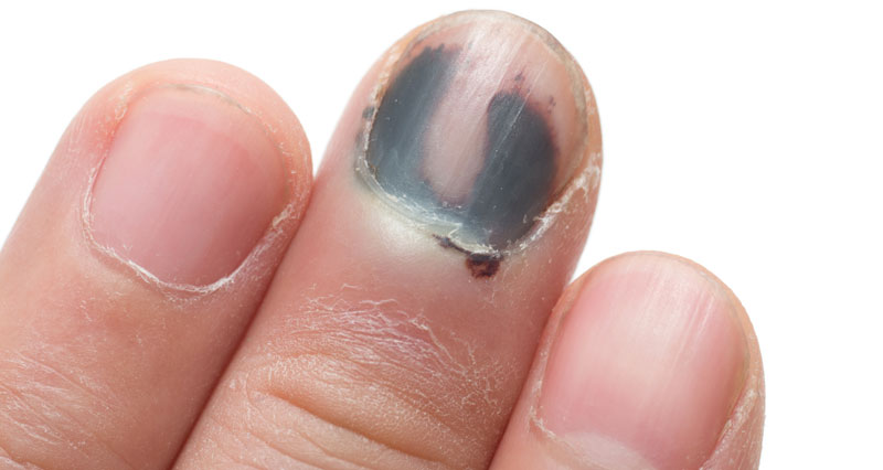 Update more than 130 black mark on nail indicates latest