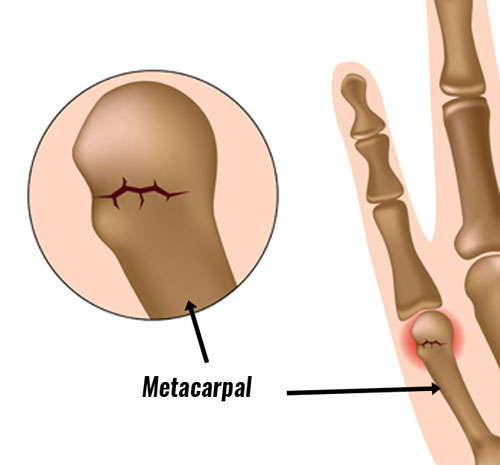 Boxer's fracture