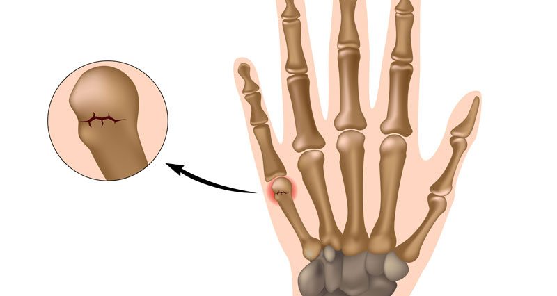 Boxer's fracture