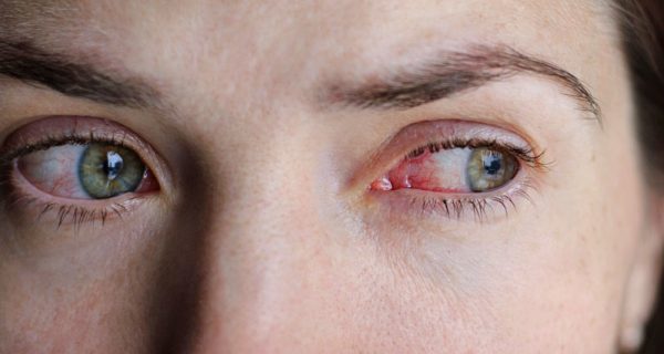 Conjunctivitis eye