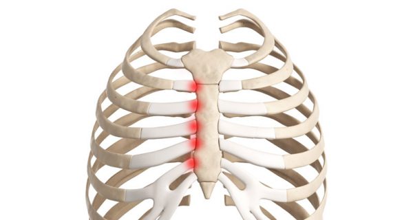 Costochondritis - Tietze's syndrome