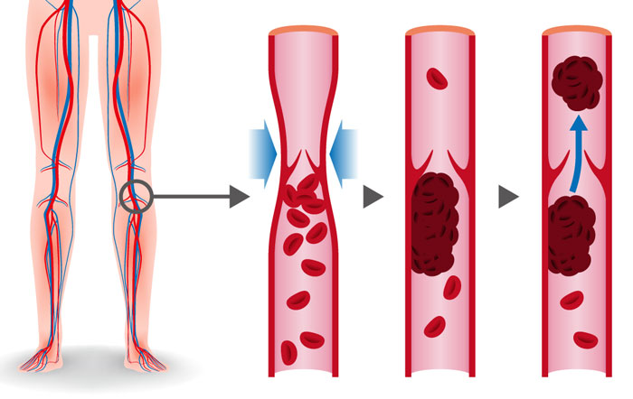 Hpv treatment no warts Wart treatment methods