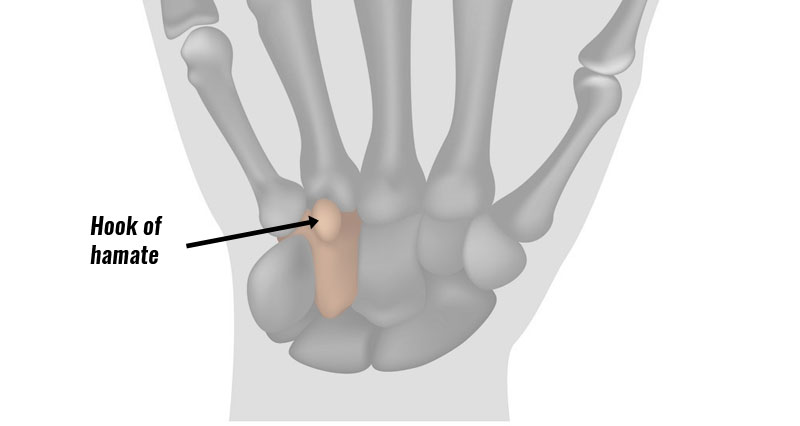 Hook of hamate fracture