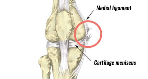 MCL sprain