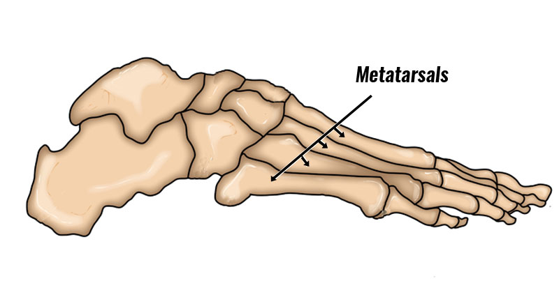 Metatarsals - Metatarsalgia