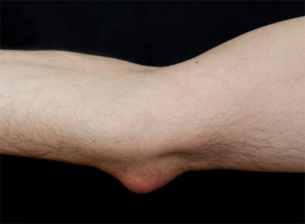 Elbow bursitis