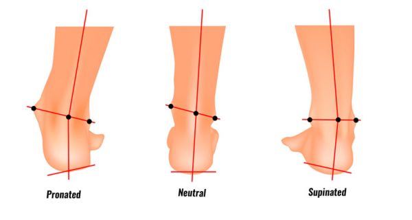 Overpronation and Supination