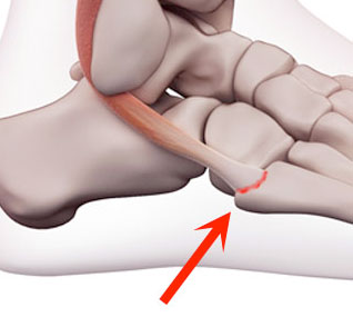 Peroneal tendon