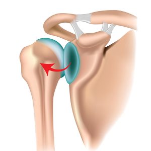 posterior shoulder dislocation